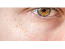 Bật mí cách trị mụn thịt đơn giản tại nhà hiệu quả được chuyên gia thẩm mỹ khuyên dùng