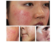 Bí Quyết Phục Hồi Da Nhiễm Corticoid Nhẹ: Hành Trình Trở Lại Làn Da Khỏe Đẹp