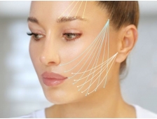 Cấy chỉ Enzyme xóa nhăn có hiệu quả bao lâu?