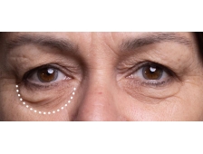 Cấy chỉ Enzyme xóa nhăn mắt quận 12 TPHCM