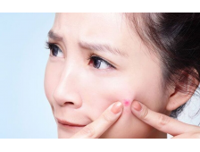 Chăm Sóc Da Tuổi Teen Bị Mụn - Bí Quyết Từ Chuyên Gia Thẩm Mỹ Viện Hàng Đầu