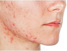 Đào tạo nghề spa cách chăm sóc da dầu nhờn hiệu quả hết mụn ngay