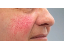 Giải Pháp Chuyên Gia: Cách Chăm Sóc Da Hay Bị Ứng Đỏ Hiệu Quả Tại Nhà