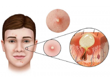 Mụn Đầu Trắng Là Gì? Cách Điều Trị Dứt Điểm Hiệu Quả Nhất