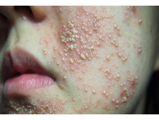 Nhận Biết Da Bị Nhiễm Corticoid: Dấu Hiệu Nguy Hiểm Và Cách Khắc Phục An Toàn