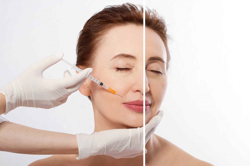 Tiêm Filler trẻ hóa da - tìm hiểu về tiêm Filler