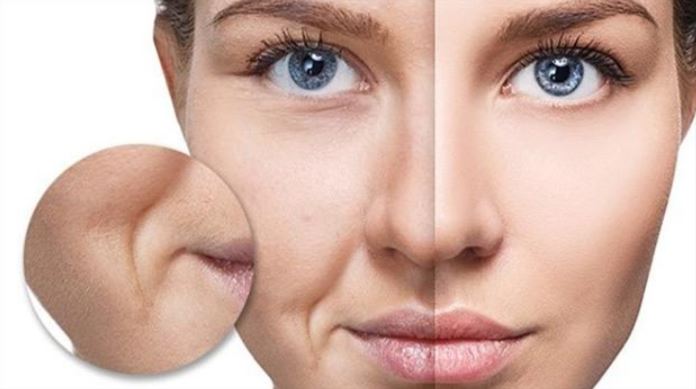 Xóa vết nhăn trẻ hóa da rãnh mũi gò má